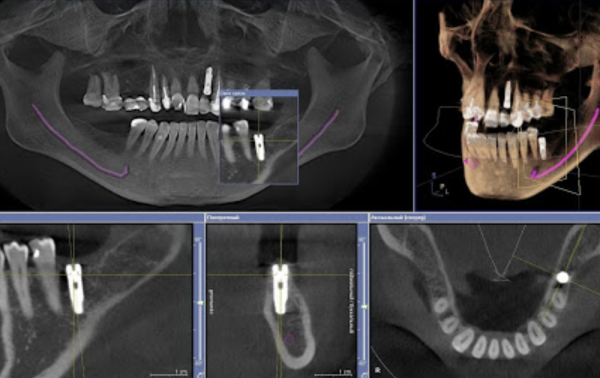 Компьютерная томография при дентальной имплантации